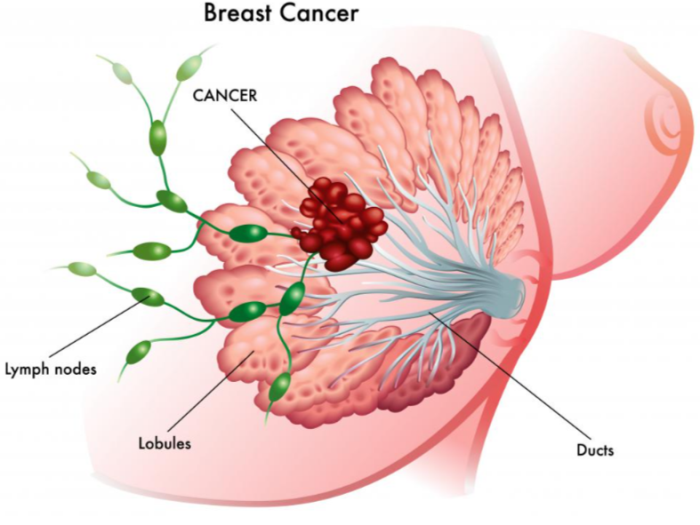 What is Breast Cancer?