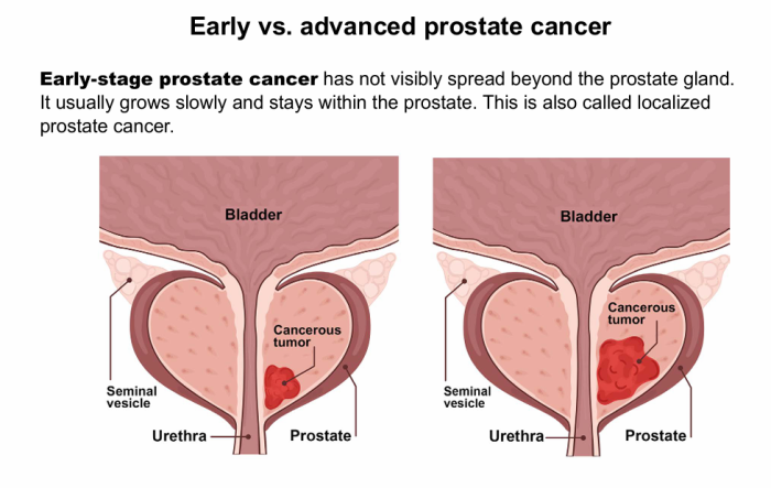 Early stage of Prostate cancer