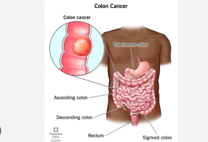 Colon Cancer Treatment in India