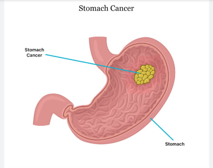 What is Stomach Cancer