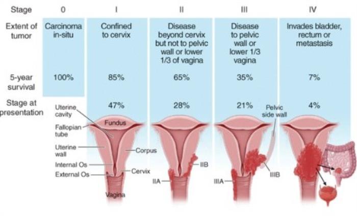 Cervical Cancer Stages