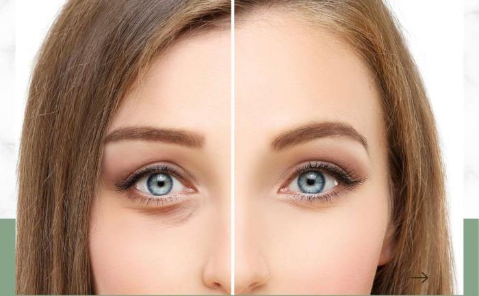 Combining Blepharoplasty with Other Facial Procedures