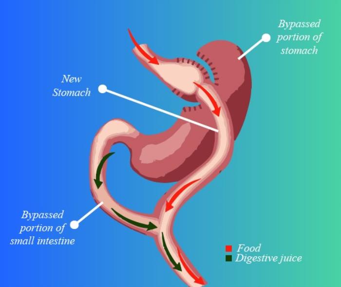 Innovations in Digestive Tract Reconstruction