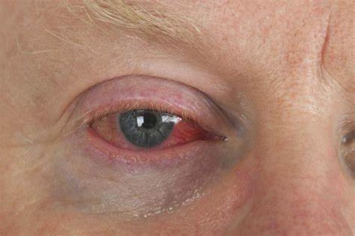 Eyelid Issues Contribute to Eye Fatigue