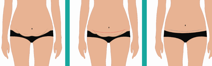 Common Conditions Requiring a Tummy Tuck