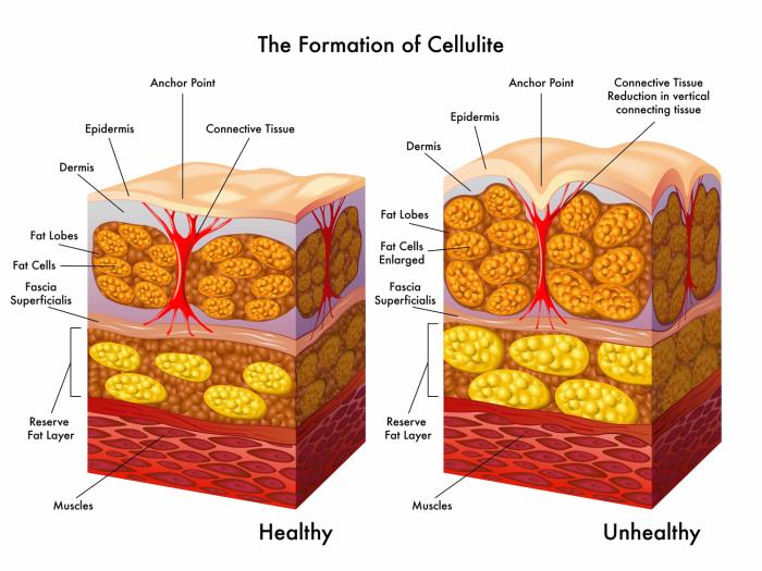 Liposuction to Reduce Cellulite