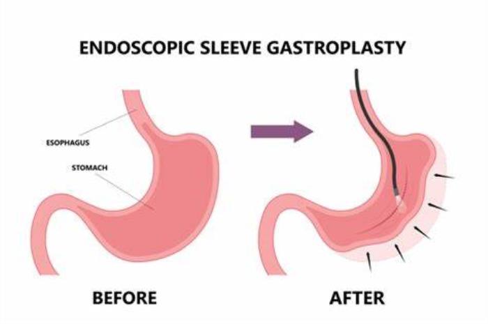 ESG and Gastroesophageal Reflux Disease