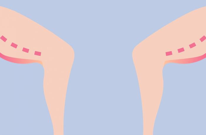 Outer Thigh Lift