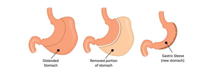 The Importance of Portion Control After Sleeve Gastrectomy