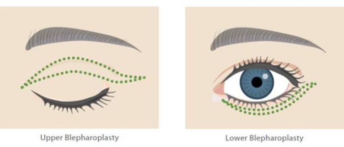 Upper vs. Lower Eyelid Surgery