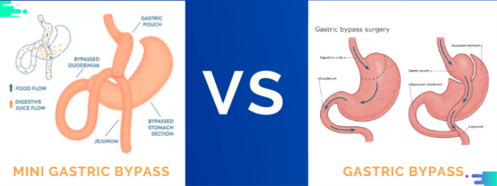 Key Differences Between Mini and Traditional Gastric Bypass