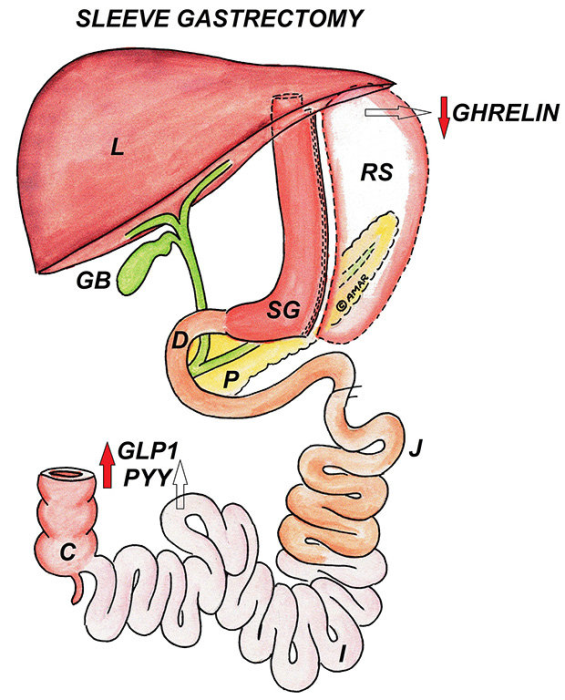 Evolution of Laparoscopic Sleeve Gastrectomy