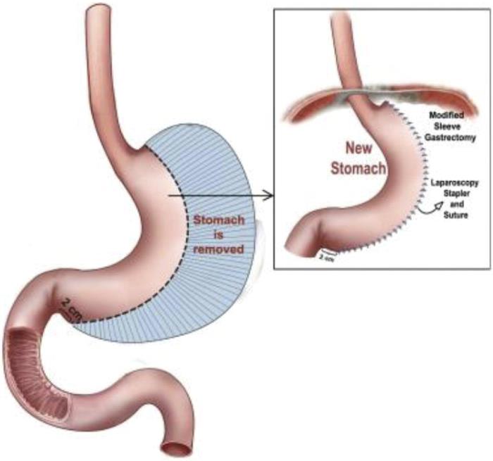 Sleeve Gastrectomy Work for Type 1 Diabetes