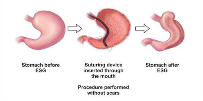 ESG Alters the Structure of the Stomach