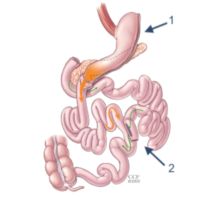 How BPD/DS Differs from Other Bariatric Surgeries