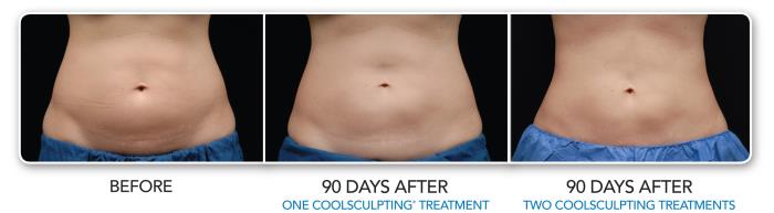 CoolSculpting for Fat Reduction