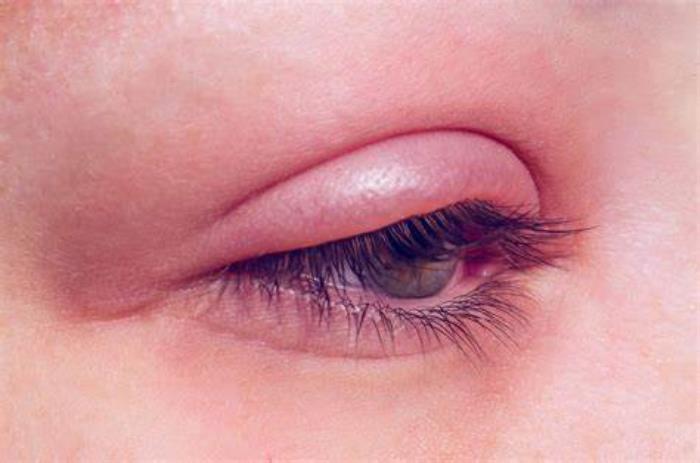 Excess Skin and Fat on the Eyelids Cause Eye Fatigue