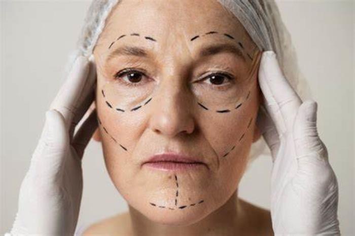 Evolution of Facelift Techniques Over Time