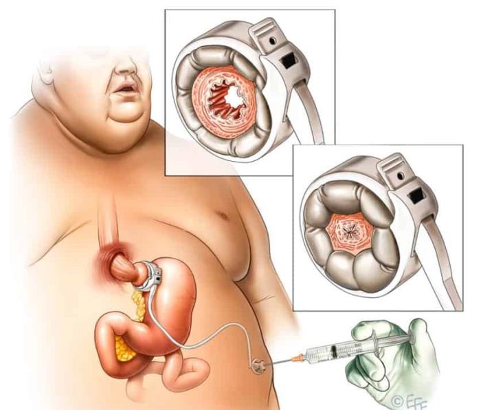 Laparoscopic Adjustable Gastric Banding (LAGB) Procedure Explained