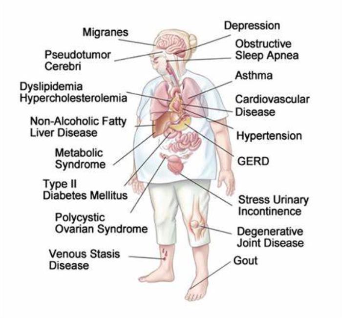 Obesity Contributes to Comorbidities