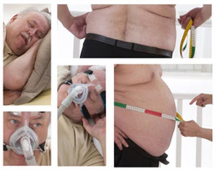  Link Between Obesity and Sleep Apnea