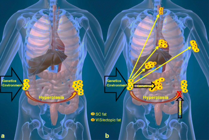 Role of Genetics in Determining Body Fat Distribution