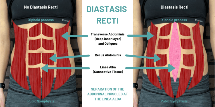 Symptoms of Diastasis Recti