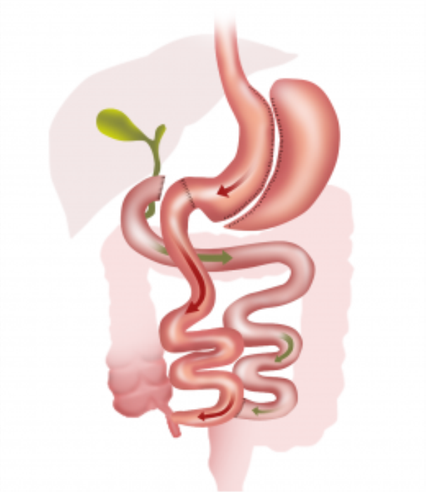 BPD/DS Affects the Digestive System