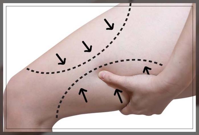 Combination Techniques for Thigh Lift