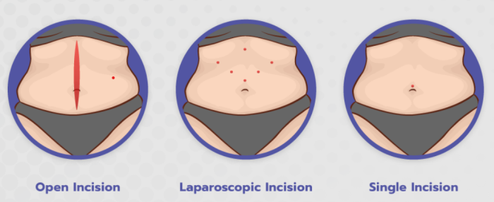 Single-Incision Mini Gastric Bypass