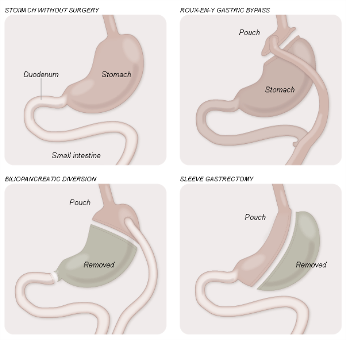 Sleeve Gastrectomy for Managing Diabetes