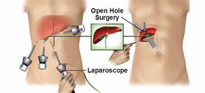 Open vs. Laparoscopic RYGB