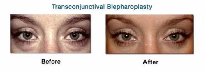 Transconjunctival Blepharoplasty