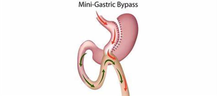 Impact of Mini Gastric Bypass on Hypertension Management