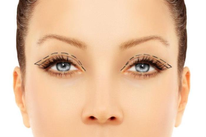 Functional vs. Cosmetic Blepharoplasty