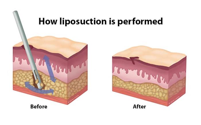 Liposuction: Is It a Non-Surgical Option?