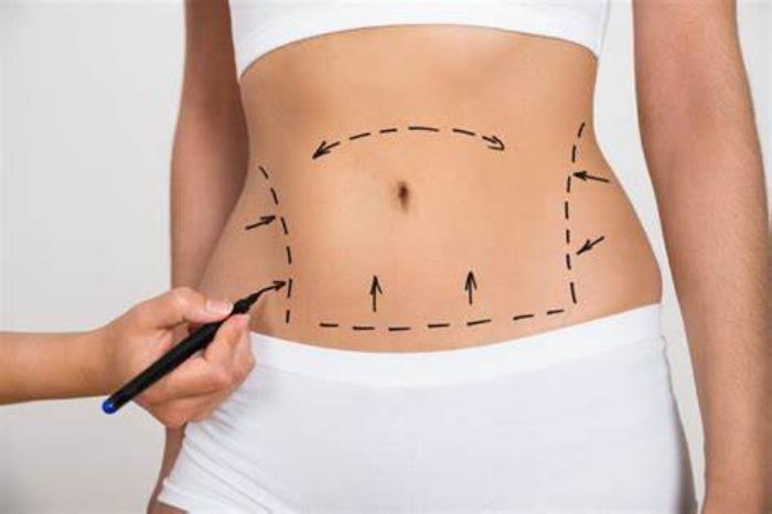 Nutrition Tips for Preparing Your Body for Liposuction