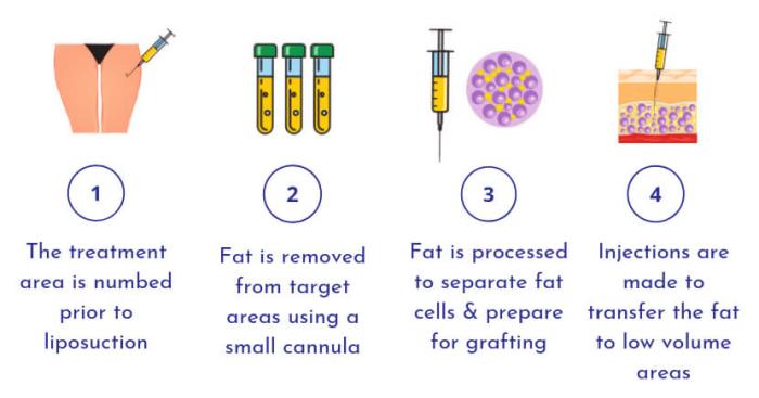  How Fat Grafting Holds Up Over Time