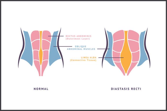 Diagnosing Diastasis Recti