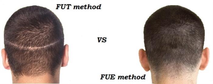 Comparing FUE and FUT