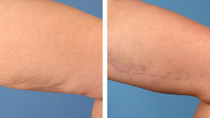 Short-Scar Thigh Lift