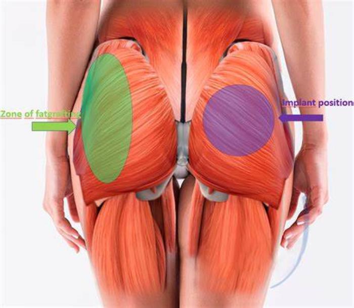 Implants with Fat Grafting