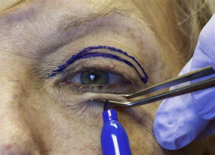 Pinch Blepharoplasty