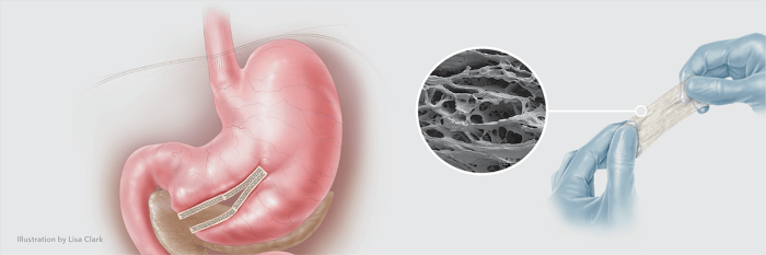 The Role of Endoscopy in Detecting Staple Line Leaks