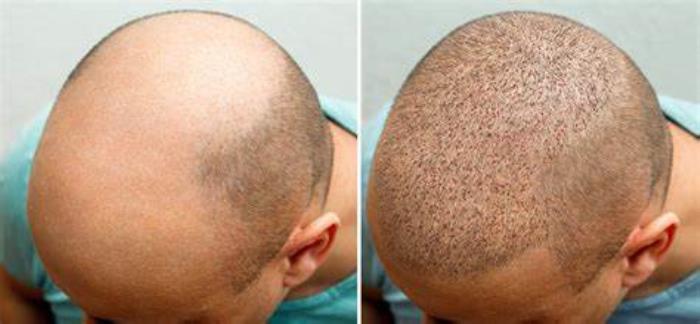 What to Expect Beyond the Base Price for hair transplant