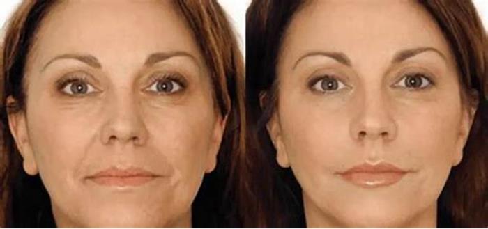 Enhancing Collagen Production Post-Facelift