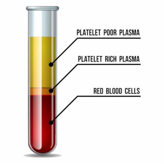 Platelet-Rich Plasma