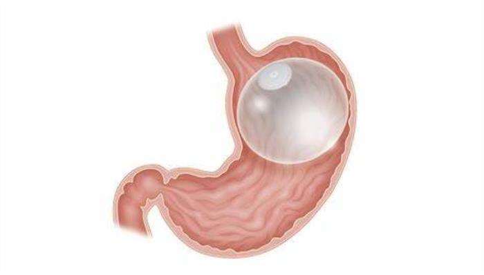 The Impact of Weight Loss from Intragastric Balloon on Cholesterol Levels