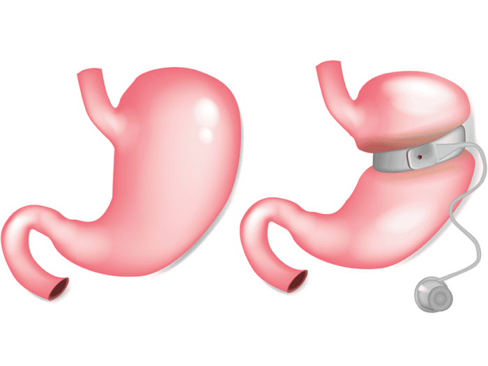 Importance of Portion Control with a Gastric Band