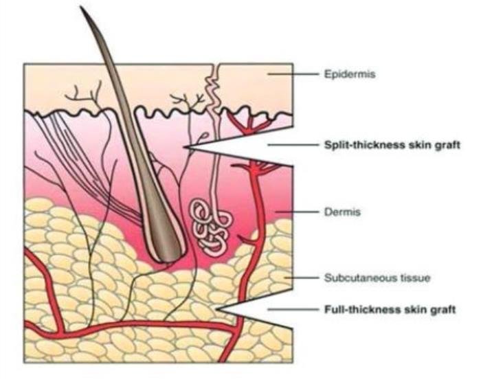 Managing Infections and Complications at the Donor Site